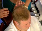 Потеря волос у мужчин не является симптомом заболевания